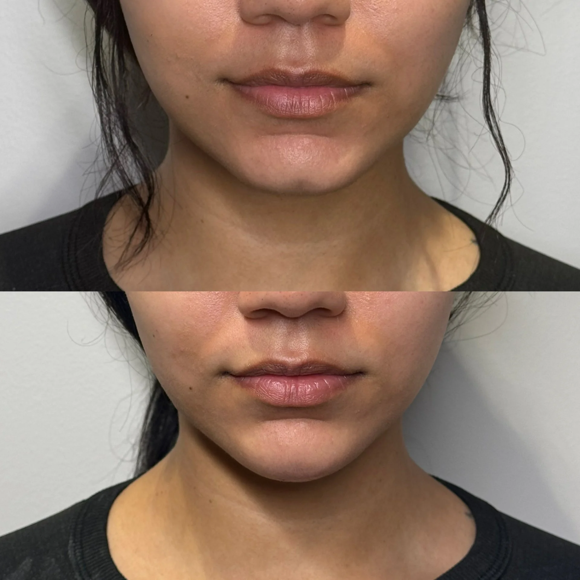 A side-by-side comparison of a woman's face before and after cleft chin ha dermal filler.