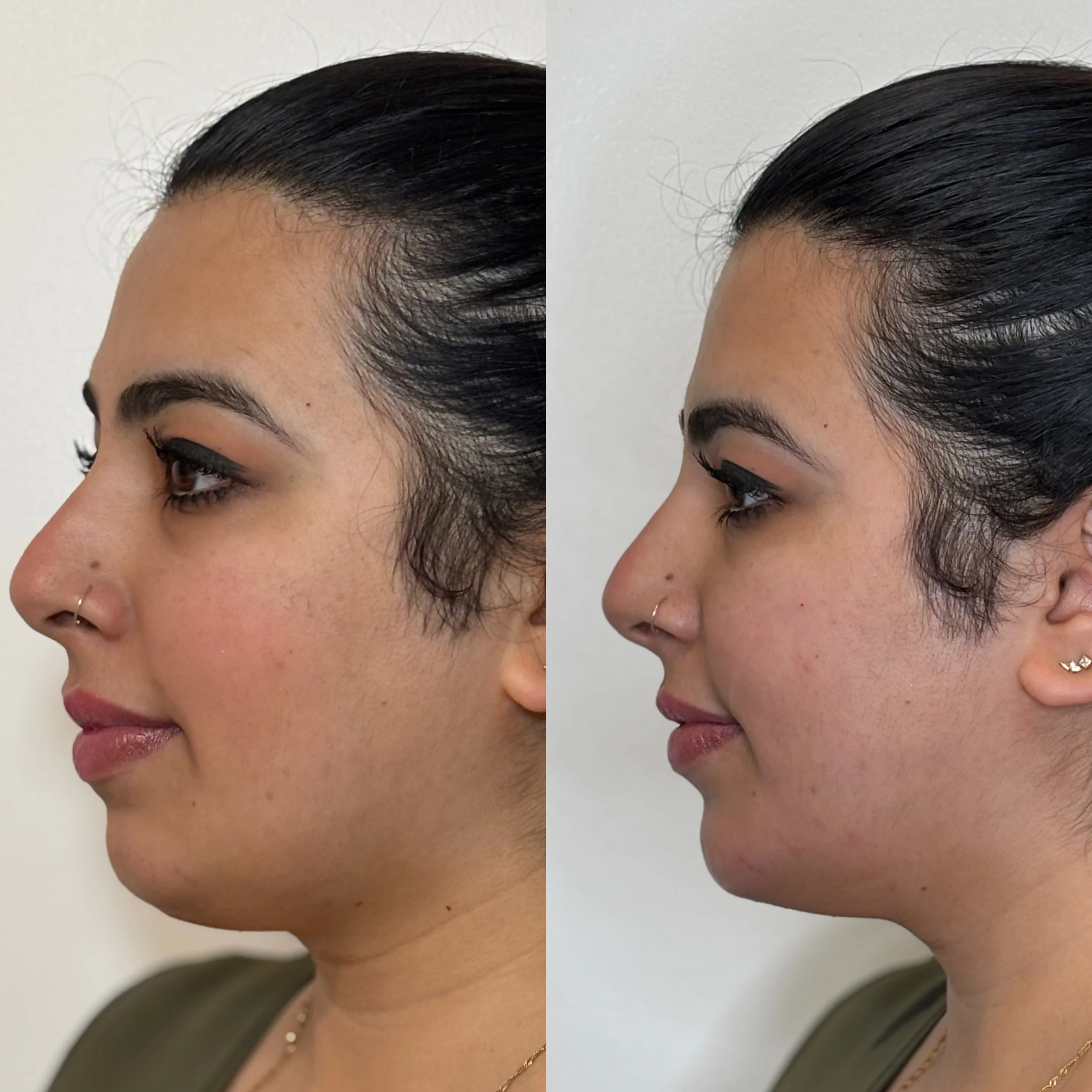 Decreasing turkey neck and tighening of jawline. 