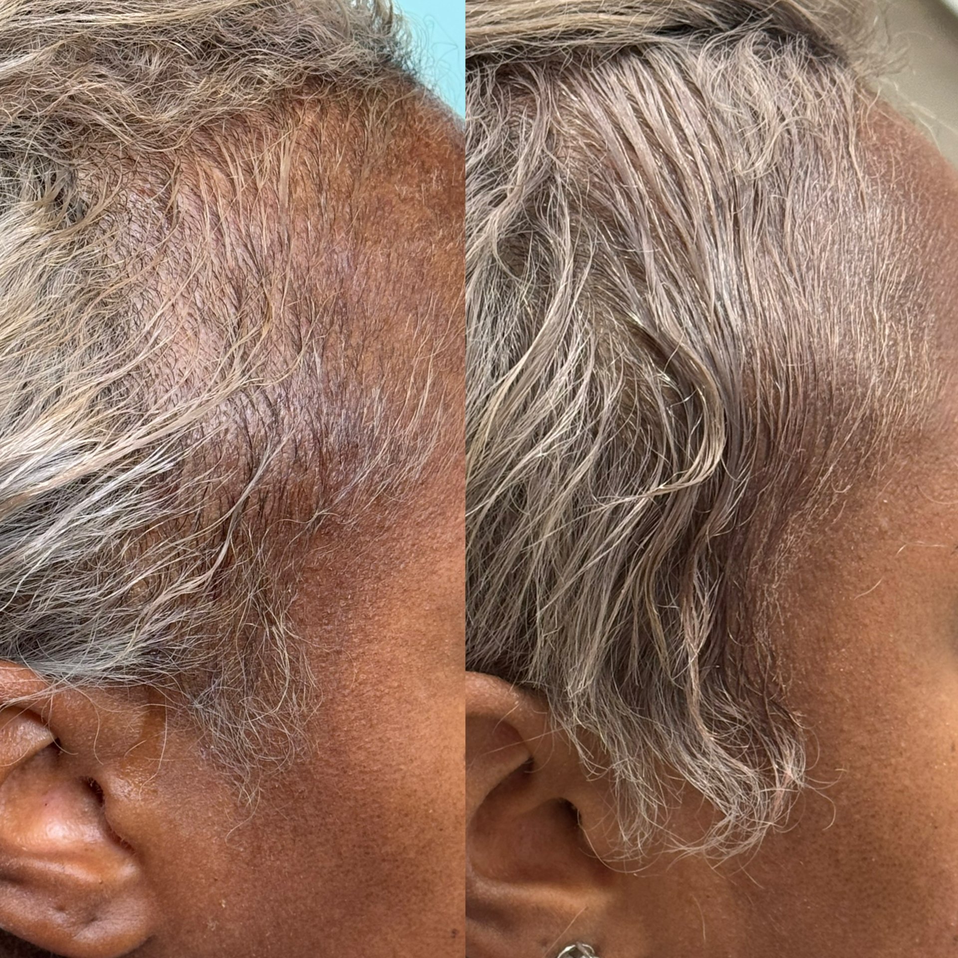 A side-by-side comparison of a person's scalp before and after hair treatment, showing improved scalp health and hair growth with PRF hair restoration.