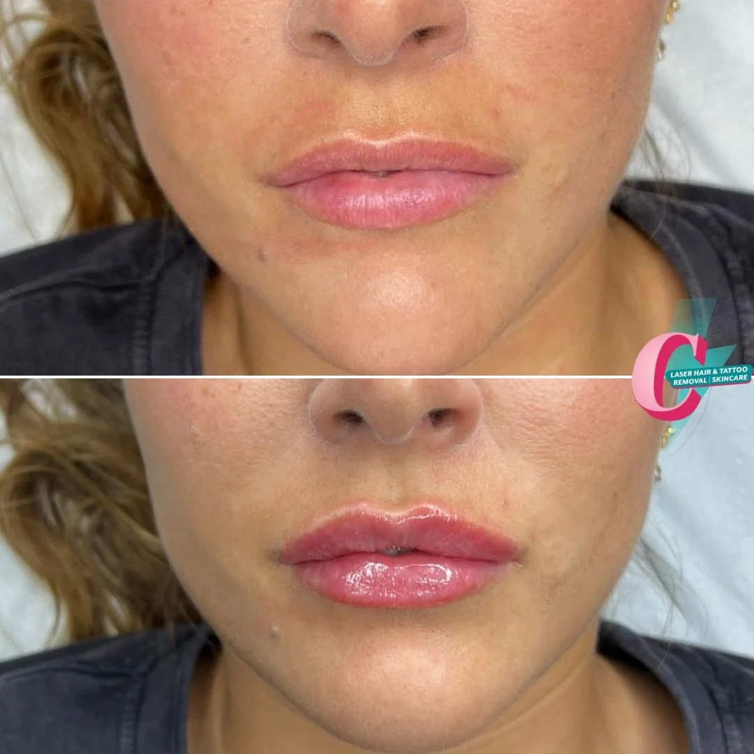 Close-up of a woman's face showing before and after lip enhancement with glossy lips.
