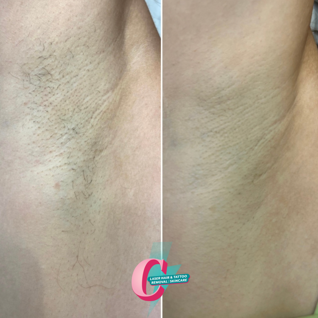 Close-up of underarm, showing before and after hair removal with smoother skin on the right side.