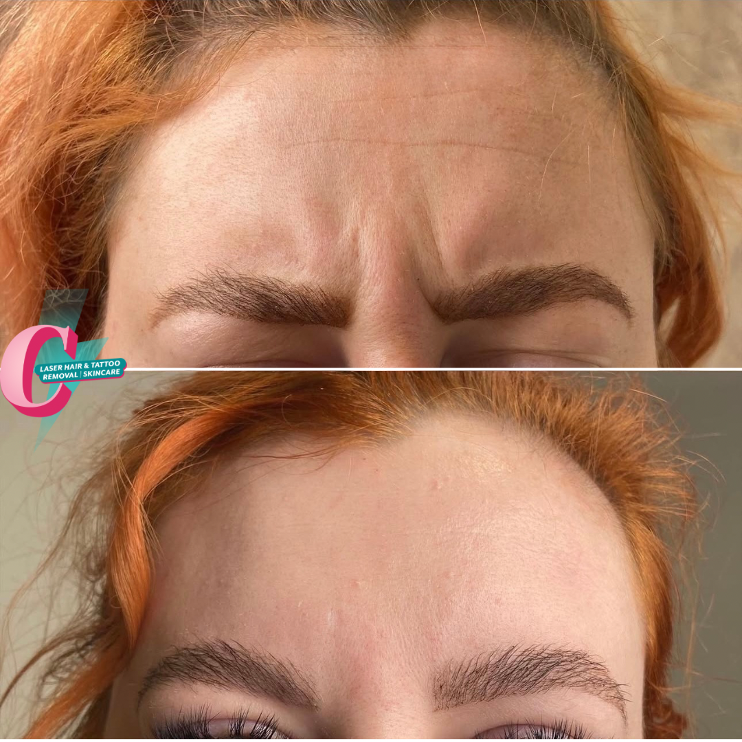 Before and after images of a woman's eyebrows showing cosmetic improvement with minimal makeup and natural skin.