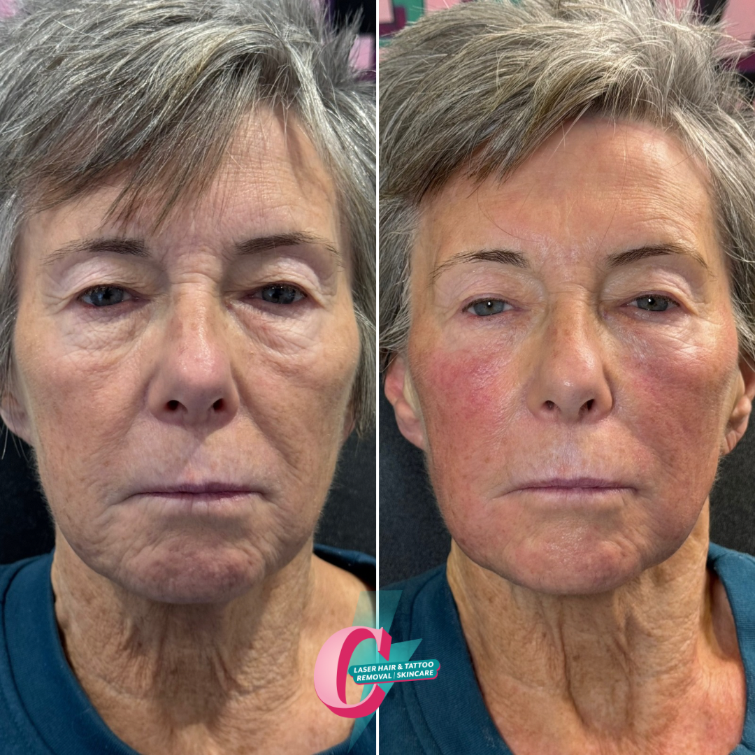 Side-by-side comparison of a woman's face before and after skin treatment, showing improved skin texture and reduced wrinkles.