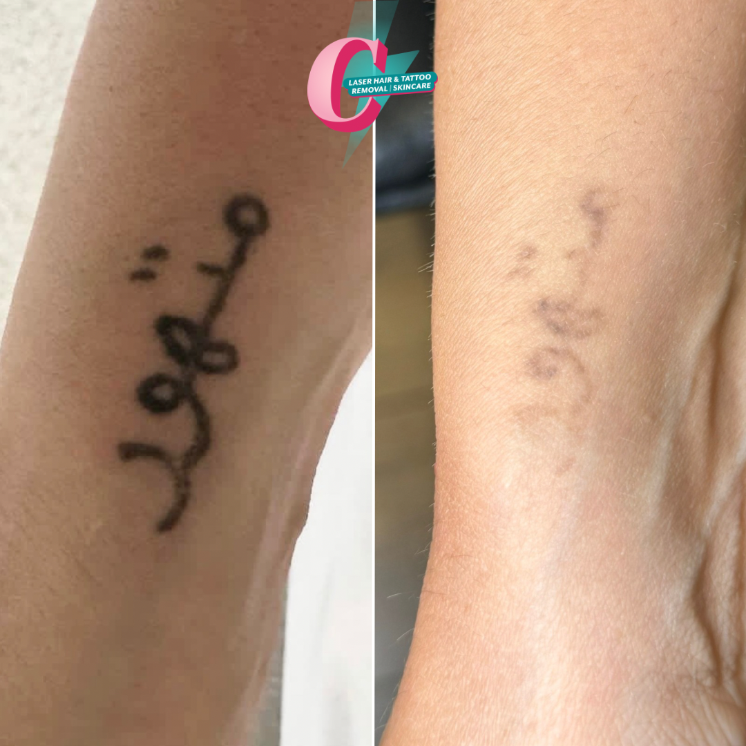 Comparison of a tattooed tattoo on the left side and a fading tattoo on the right side on a person's inner arm.