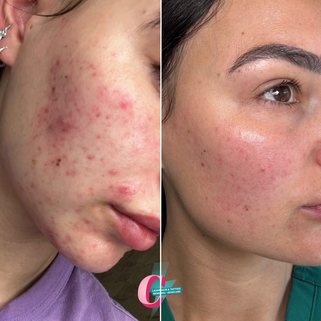 Side-by-side comparison of a woman's face showing before and after skin treatment, with improved skin clarity and reduced acne.