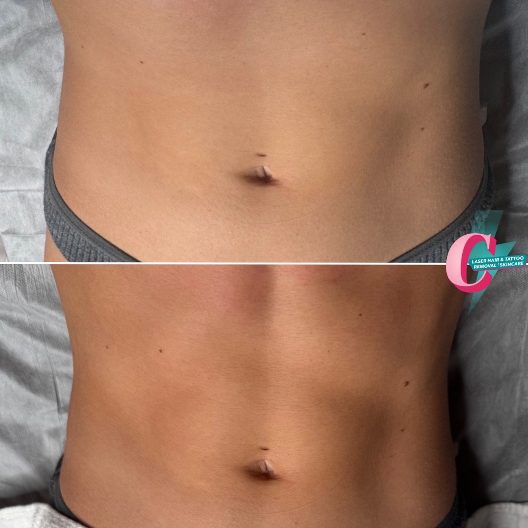 Before and after images of a person’s toned abdominal area, showing the skin's improved appearance.