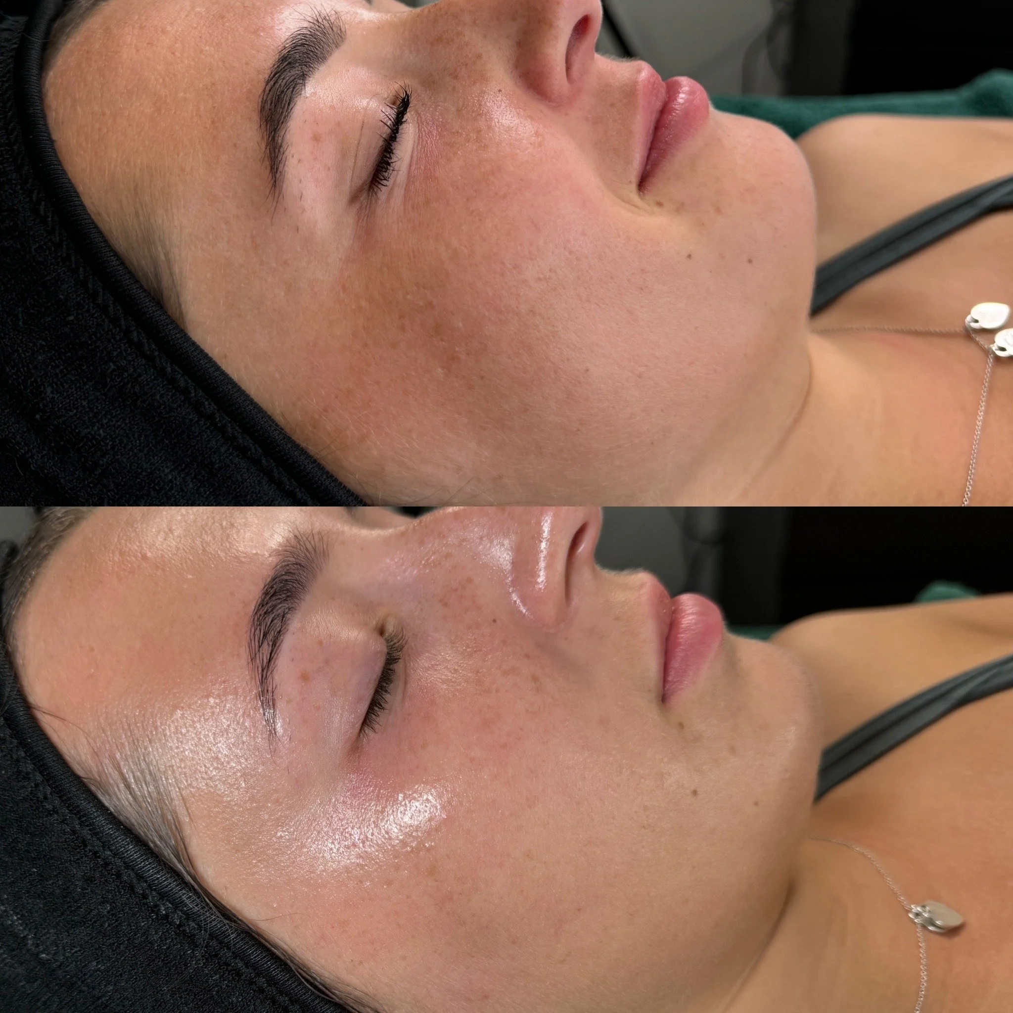 Comparison of a woman's face before and after a skincare treatment, showing improved skin texture and glow.