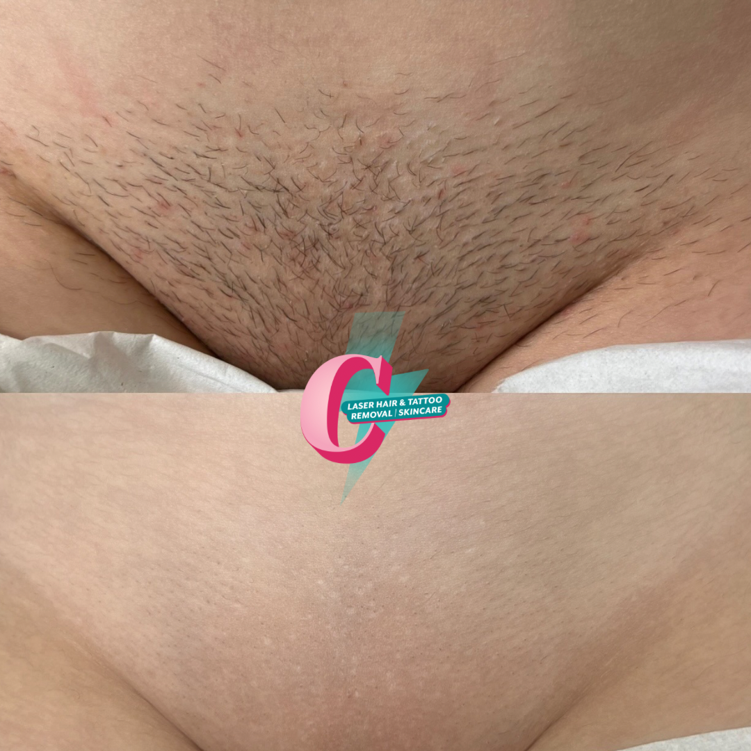 Comparison of a male's genital area before and after laser hair removal, with the after image showing smooth, hair-free skin and a logo for laser hair and tattoo removal services.