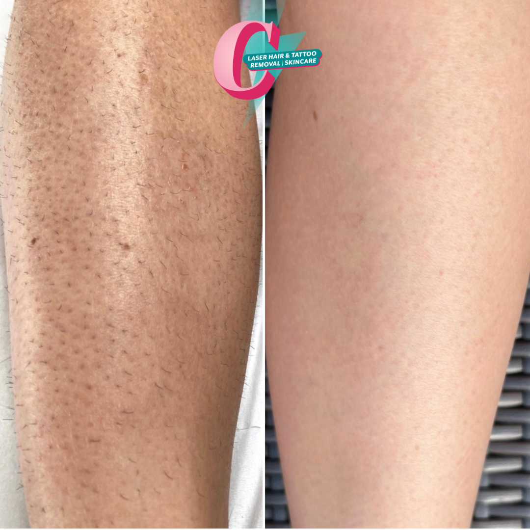 Before and after images of a person's leg showing the removal of hair, with a logo for laser hair and tattoo removal and skincare.