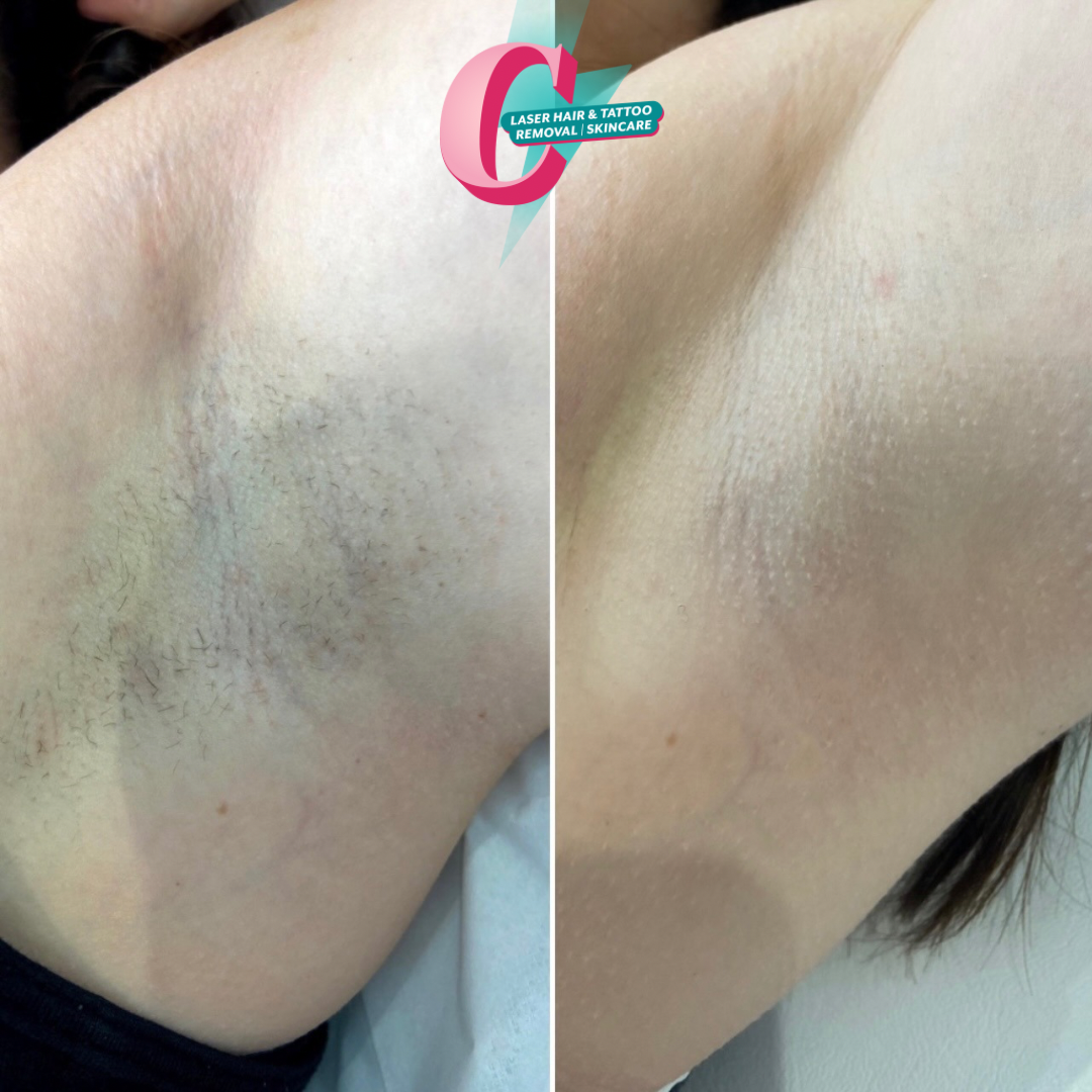 Comparison of underarm hair before and after laser hair removal, showing significantly less hair and smoother skin on the right side.