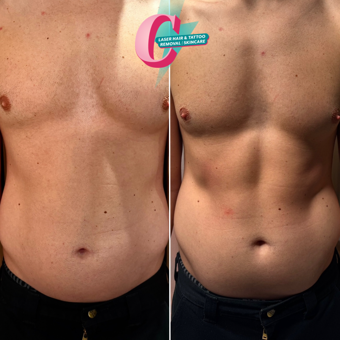 Side-by-side before and after photos of a woman's torso showing the results of laser hair and tattoo removal therapy, with visible reduction in hair and tattoo.