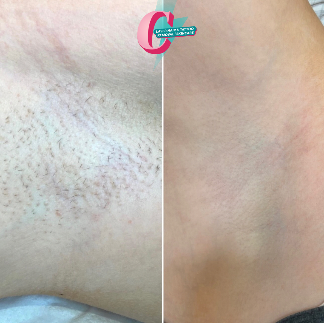 Comparison of underarm skin before and after laser hair removal, with a logo for a laser hair removal and skincare clinic at the top.