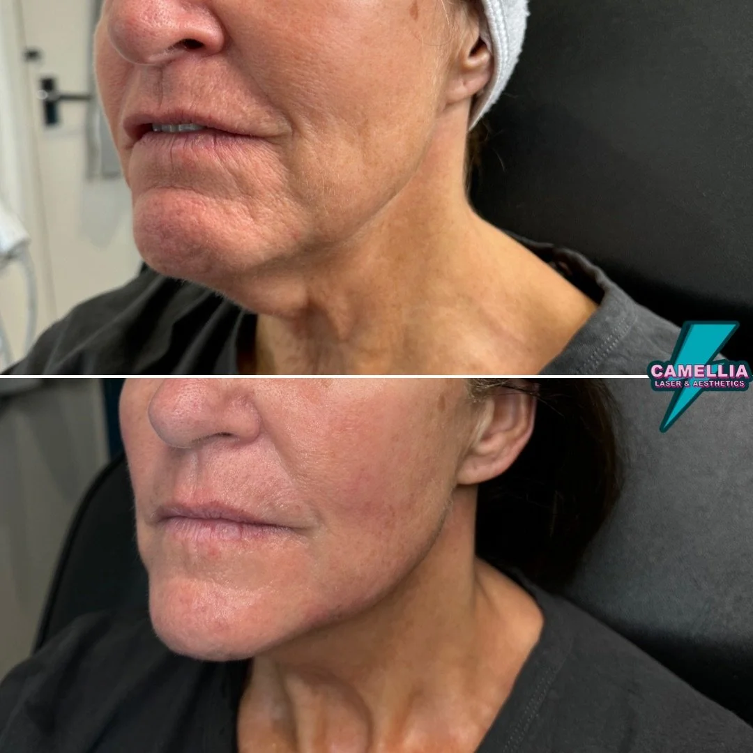 Side-by-side comparison of a woman's face before and after a cosmetic procedure showing smoother skin and improved skin texture on the lower face and neck.