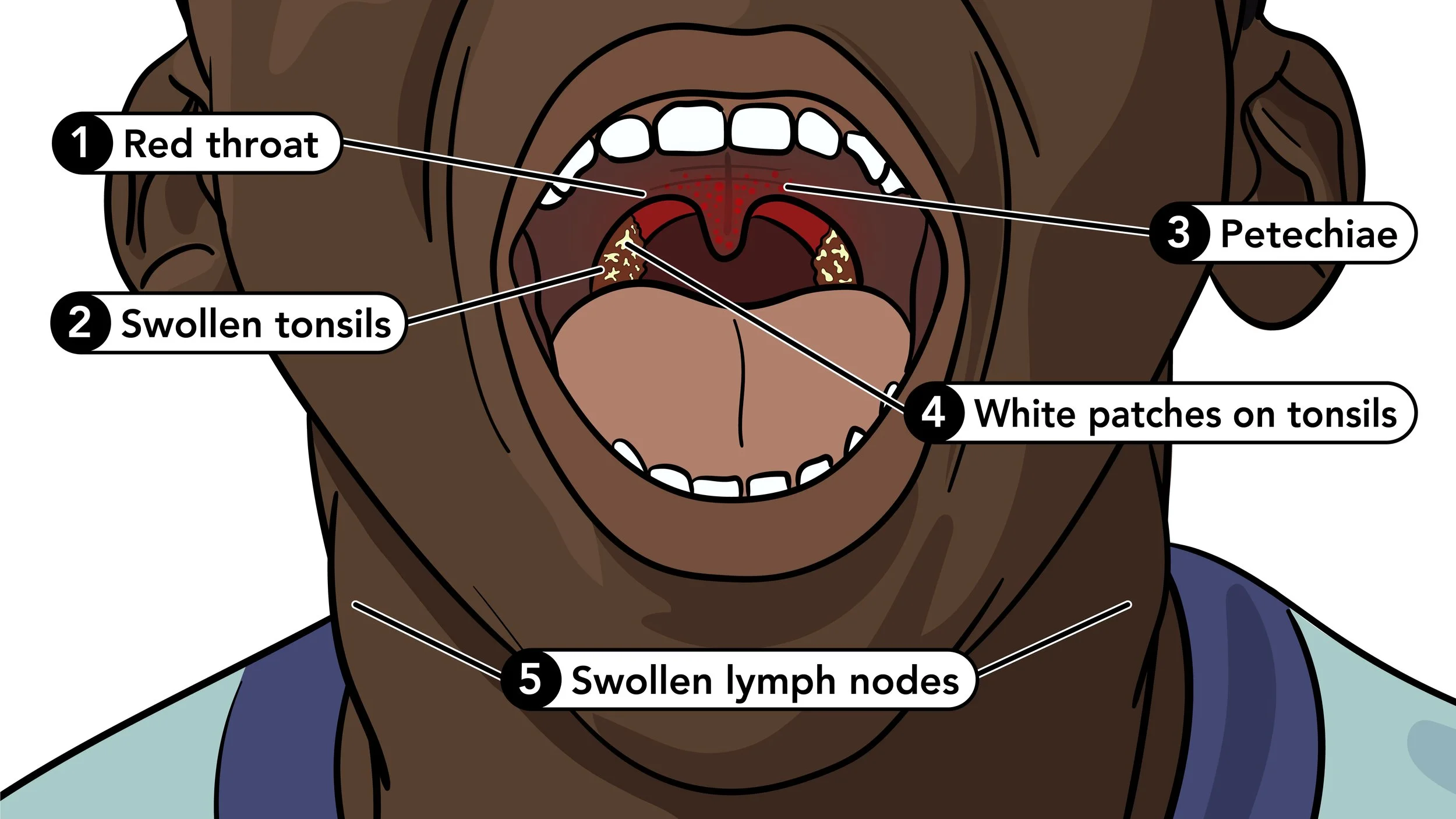 Strep Symptoms