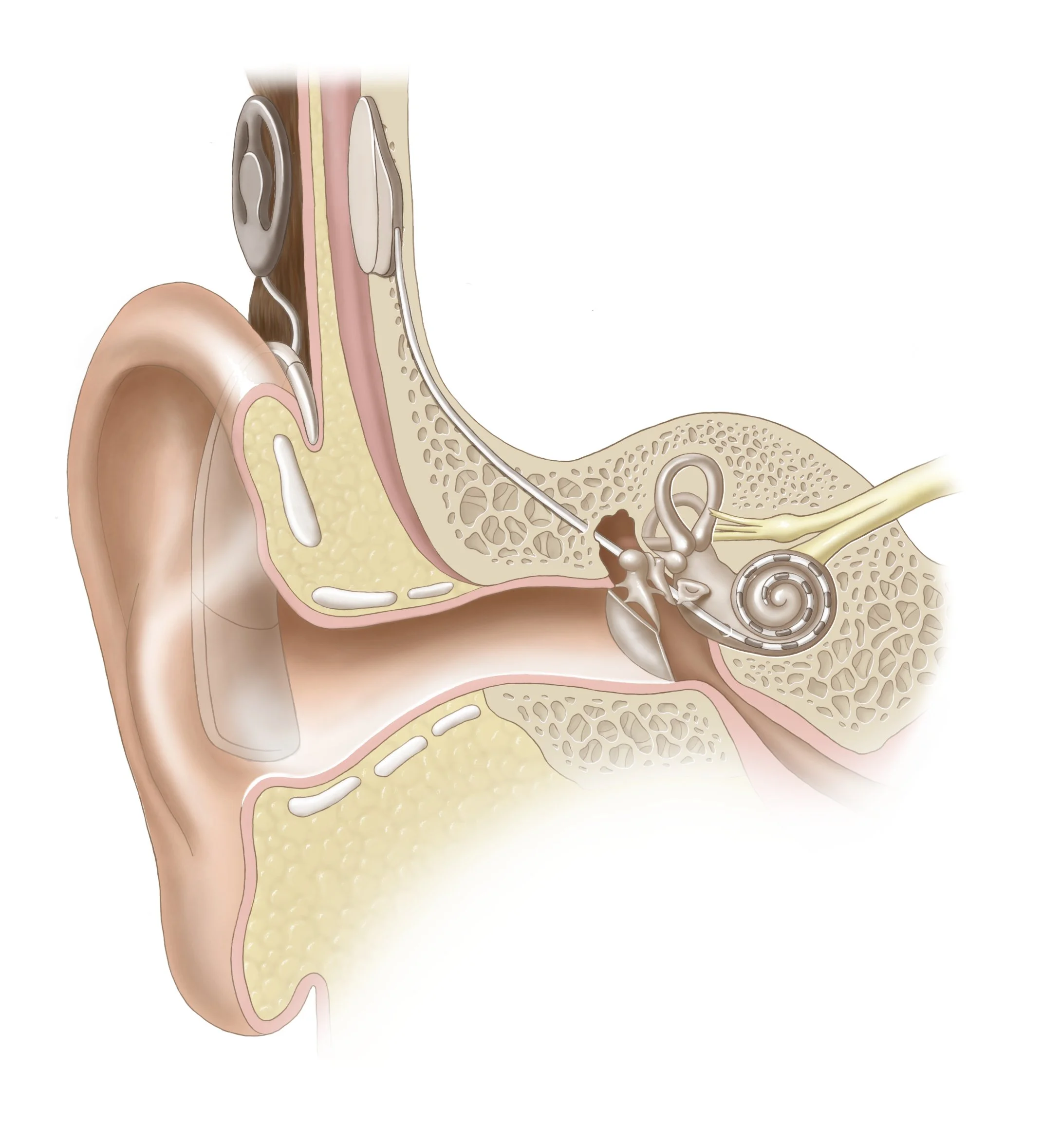 Cochlear Implant
