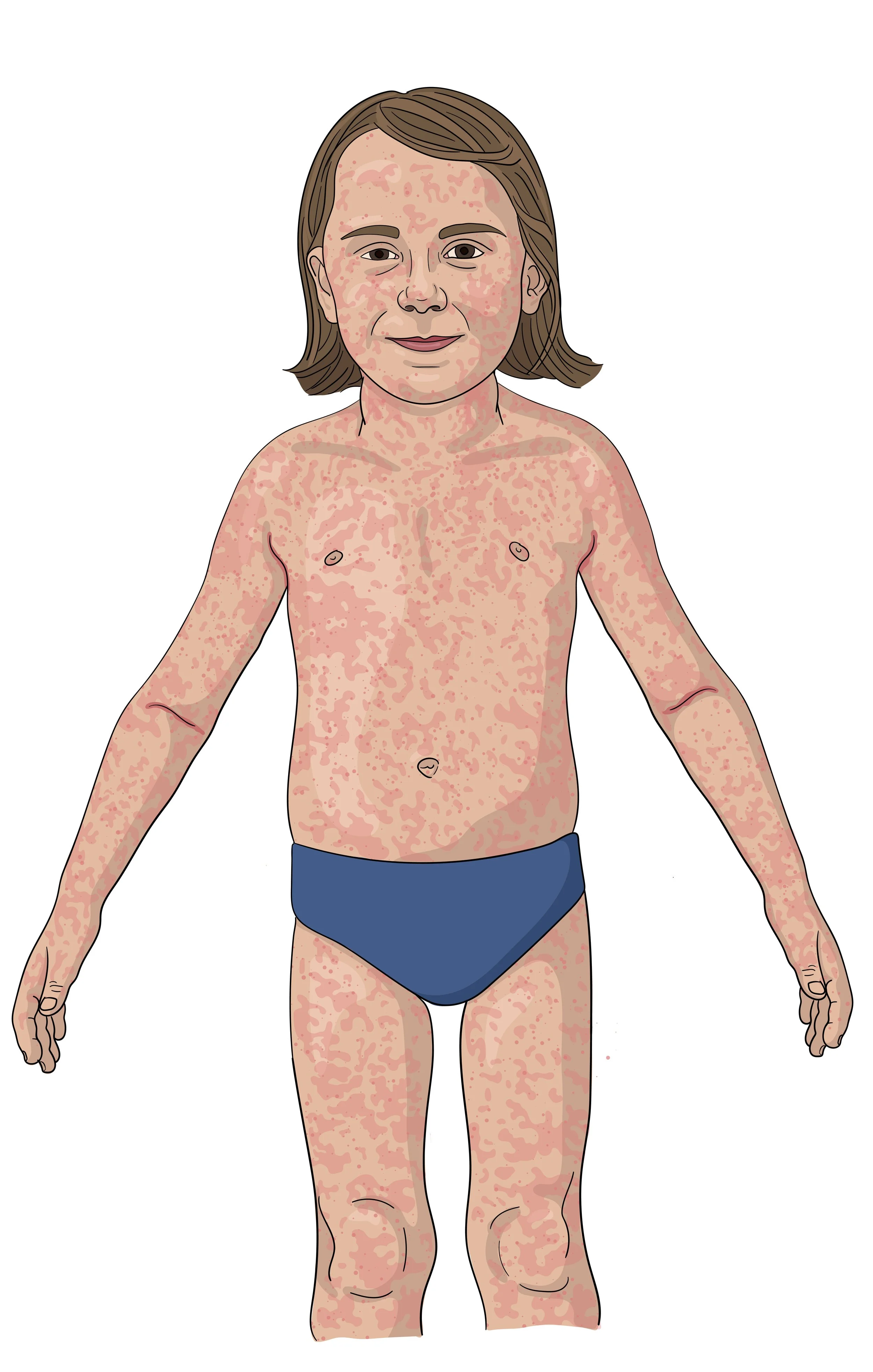 Scarlet Fever Rash