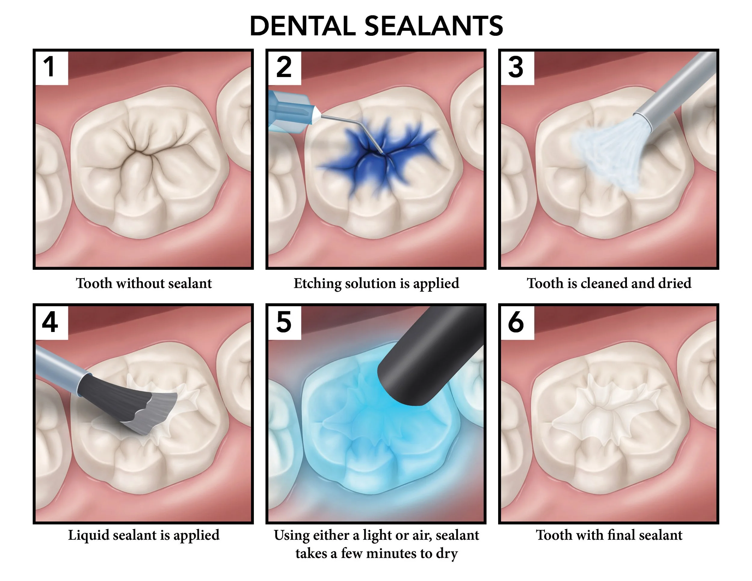Dental Sealants