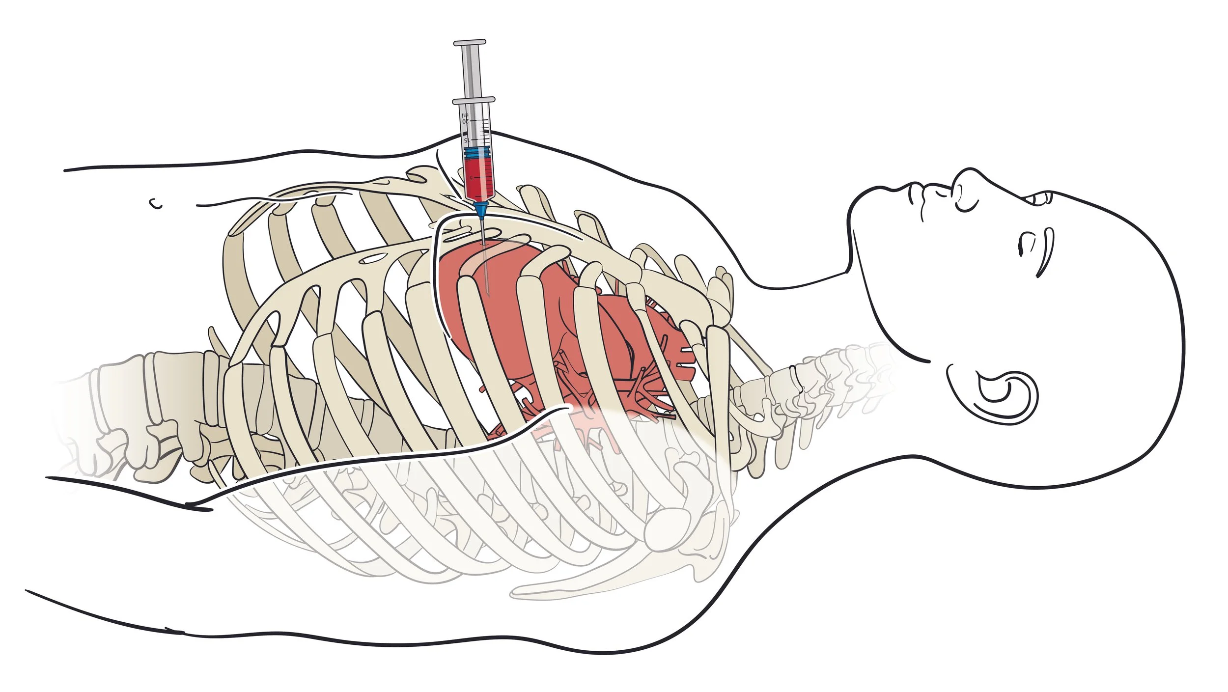 Parasternal Sampling