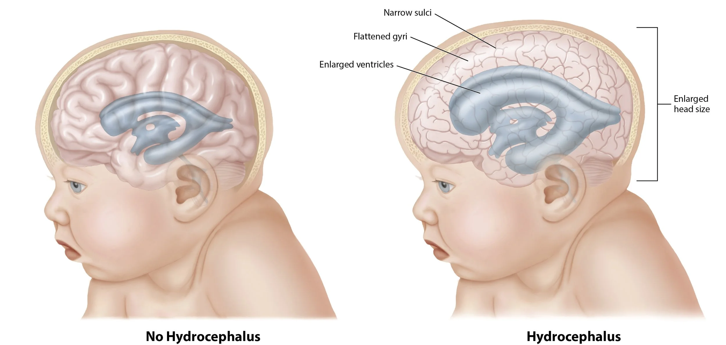 Hydrocephalus