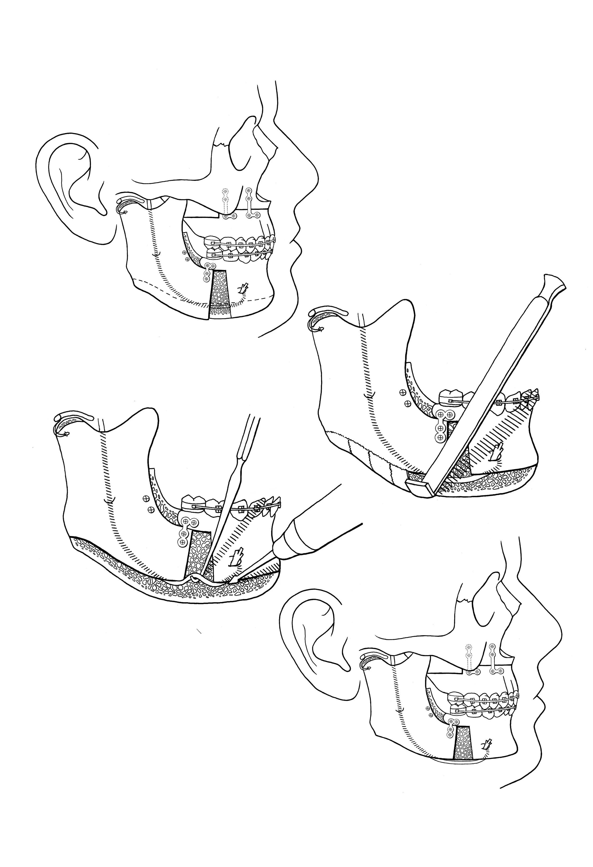 Oral Surgery Procedure