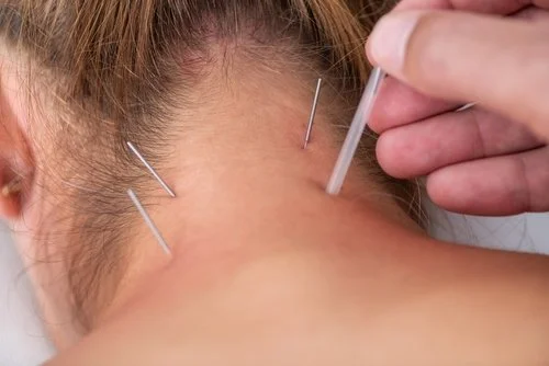 Dry Needling