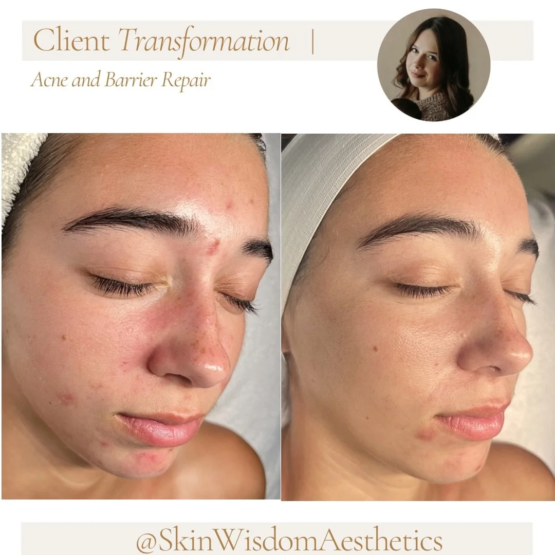 These results are from just ONE facial and 3 simple product adjustments&hellip; imagine the progress over the next few weeks. 🤩 Skincare is EVERYTHING!

Instead of solely focusing on treating acne, we recognized that this client&rsquo;s skin was in 