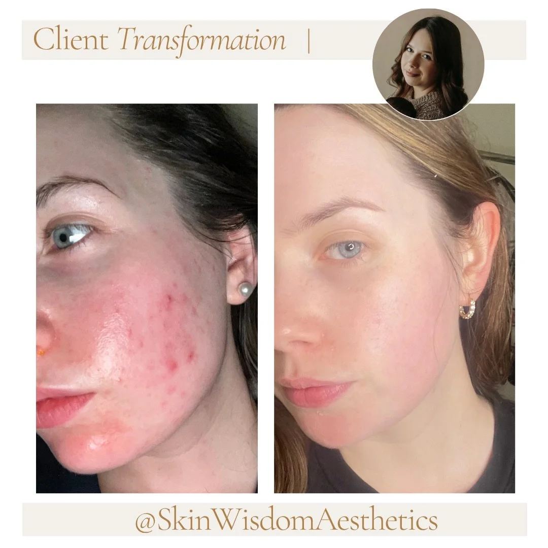 These before &amp; afters are proof that small, intentional changes over time can create incredible results. ✨

It&rsquo;s been years of trial and error, learning what my skin truly needs, investing in education, perfecting my craft as an esthetician