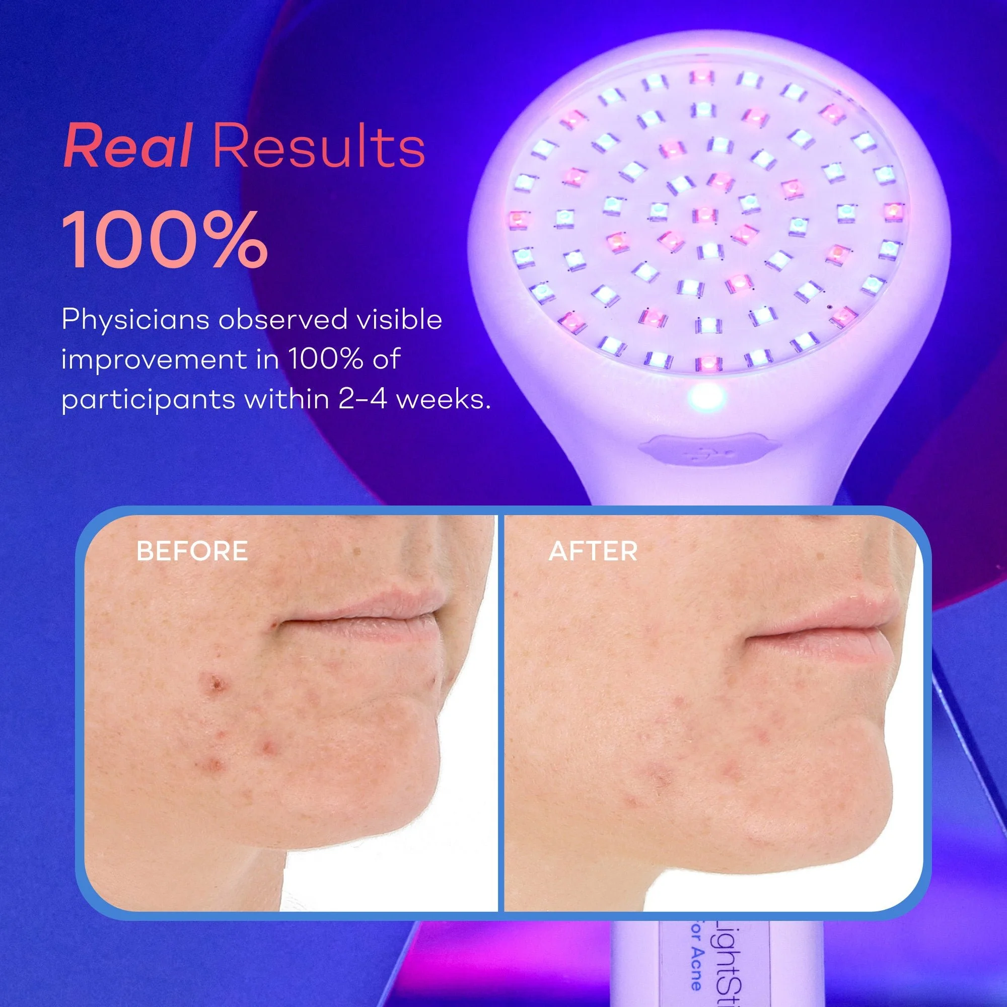 LED light therapy acne treatment device with before-and-after facial skin photos and text claiming visible improvement in 100% of participants within 2–4 weeks