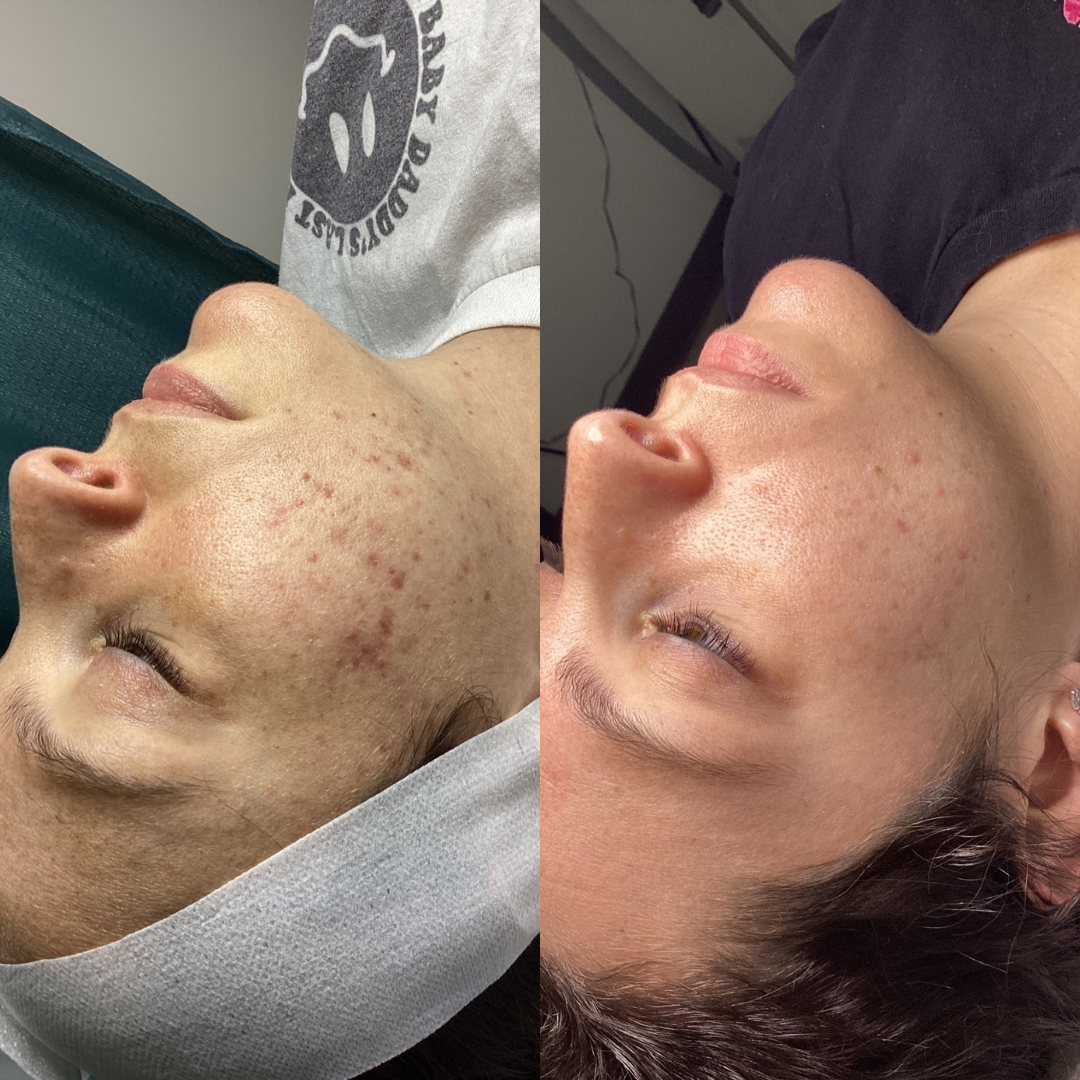Side-by-side close-up before-and-after photos showing reduced facial acne and redness on a person’s cheek and jawline