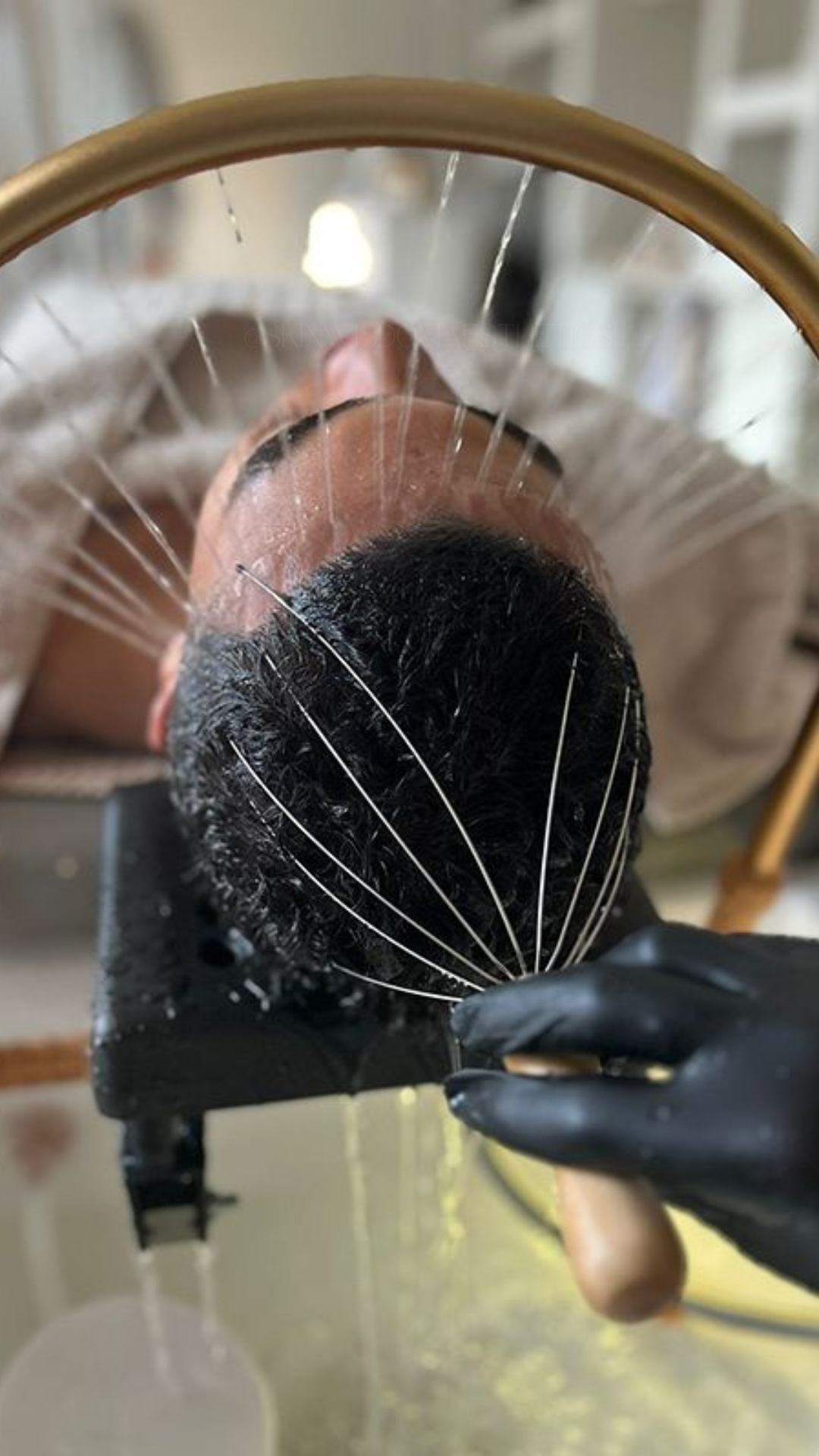 A person lying on a table with their head secured in a headrest, receiving an acupuncture treatment. Thin needles are inserted into their face and head, with some needles attached to thin wires. The practitioner wearing black gloves holds a small tool near the person's face.