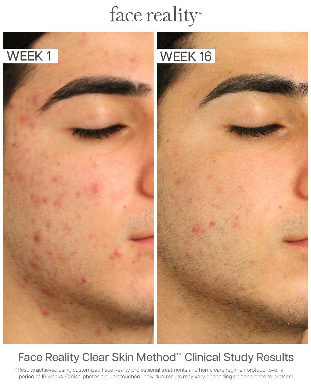 Side-by-side comparison of a person's face showing clear skin before and after 16 weeks of skincare treatment. The left image shows acne and redness, while the right image displays smoother, clearer skin.