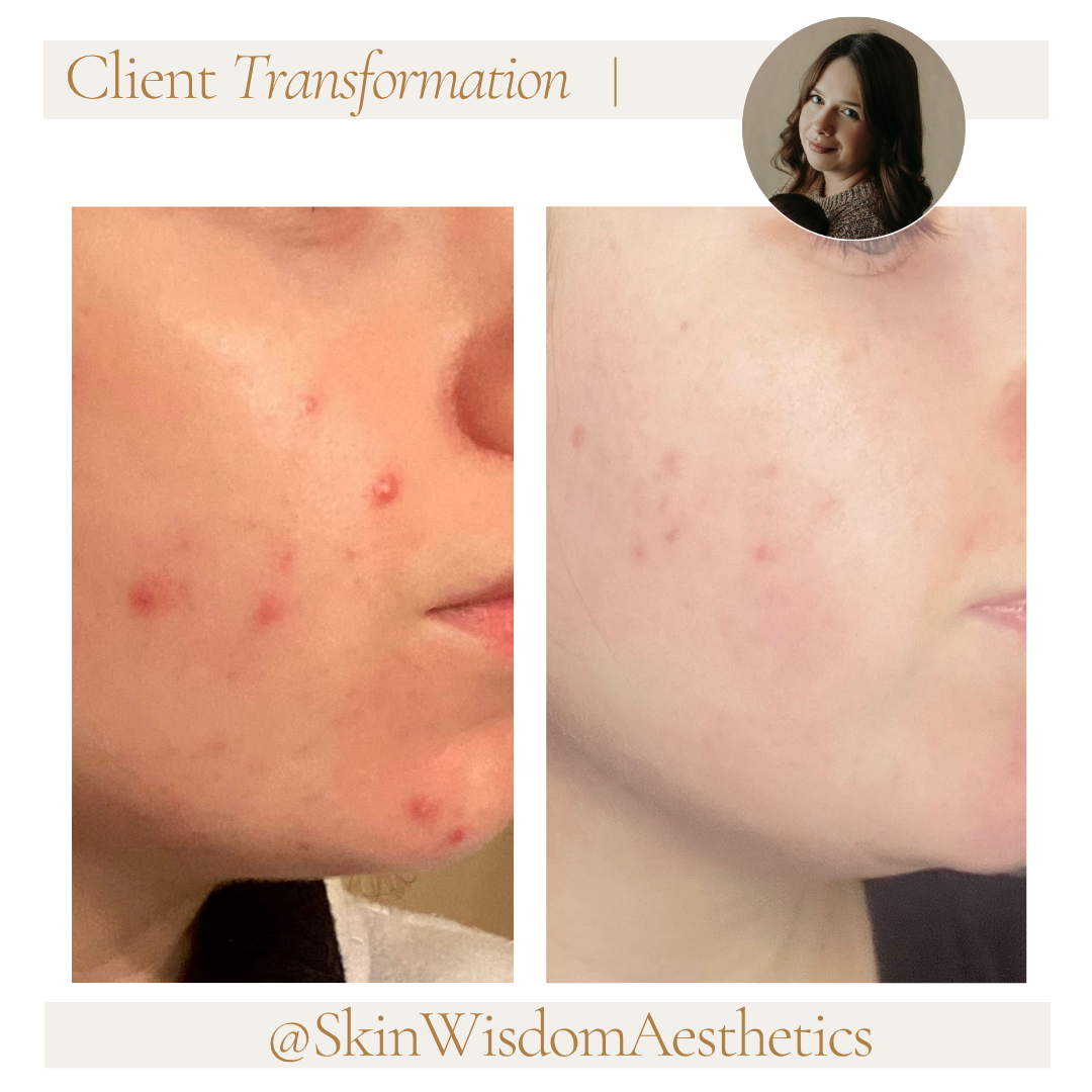 Before and after images showing skin transformation, with clearer skin in the after photo, after treatment for acne scars and blemishes.