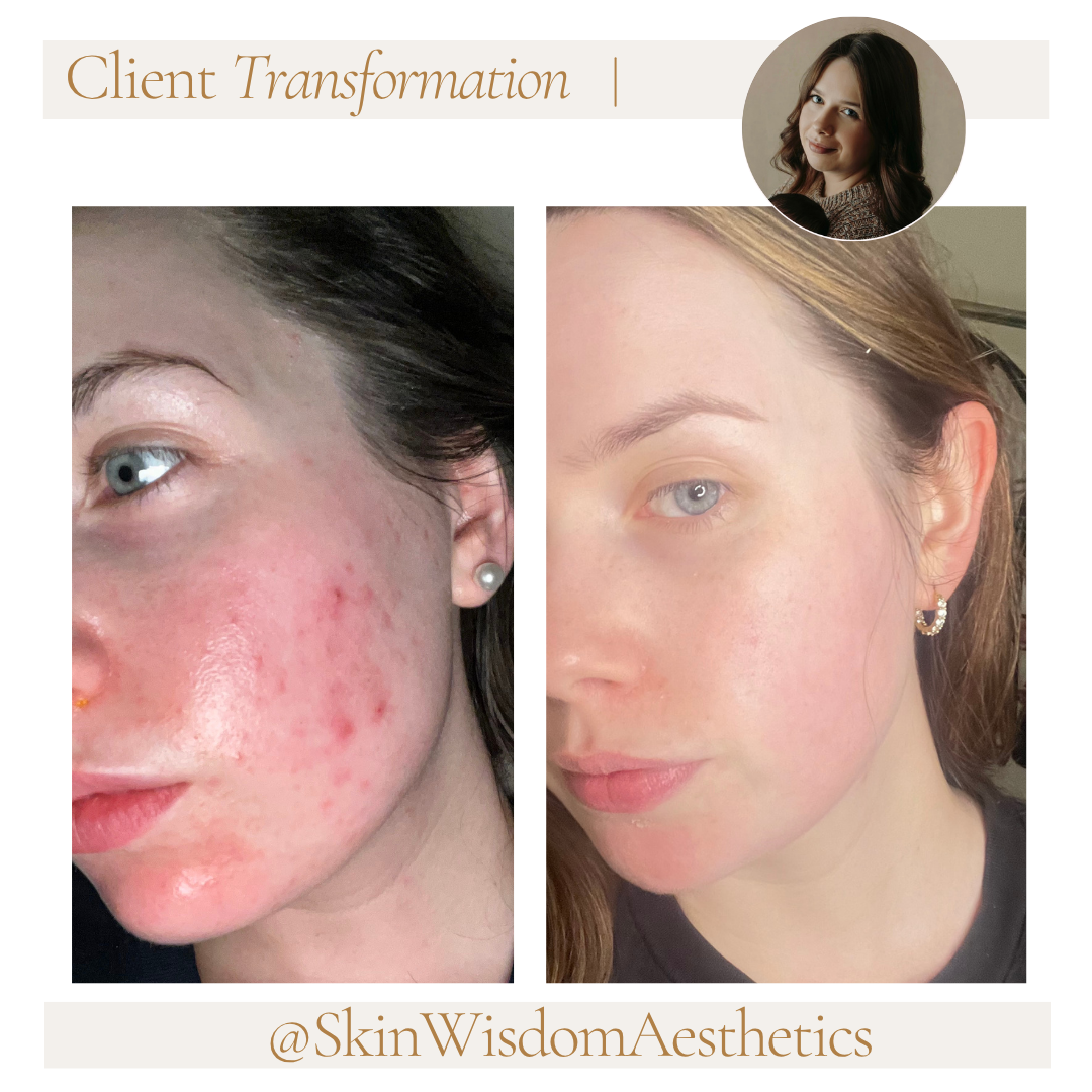 Before and after images of a woman's face showing skin transformation, with clearer skin in the after photo, captioned 'Client Transformation' and the Instagram handle '@SkinWisdomAesthetics'.