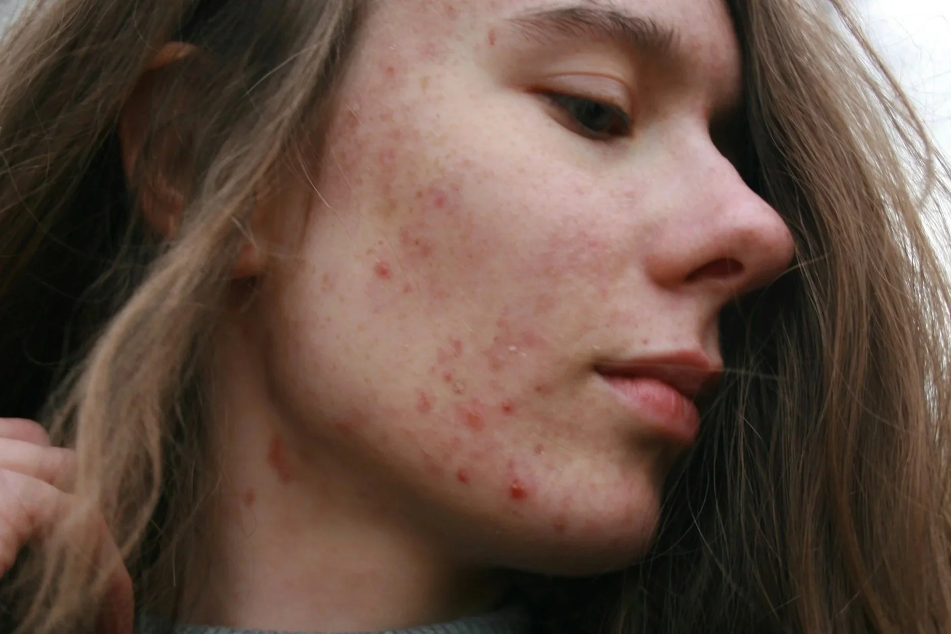 Close-up side profile of a young woman with acne breakouts and inflamed blemishes on her cheek and chin