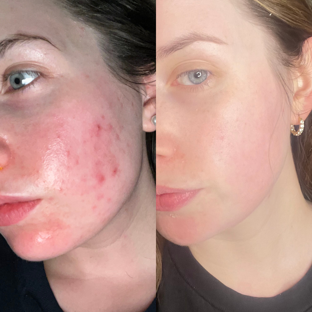 Side-by-side close-up before-and-after photos showing reduced facial redness and acne blemishes on a woman’s cheek.