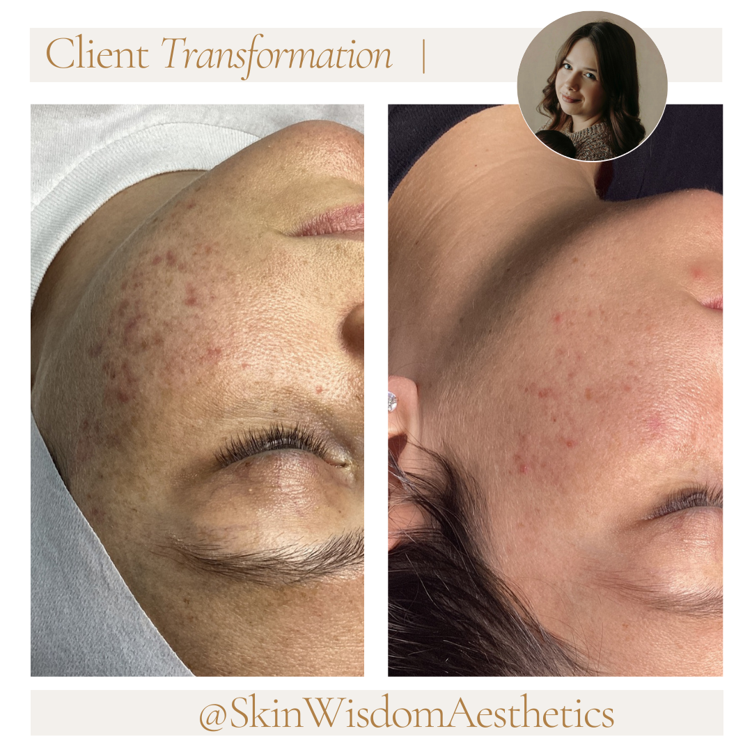 Comparison of a woman's skin before and after a transformation treatment, showing clearer skin with fewer blemishes on the right.