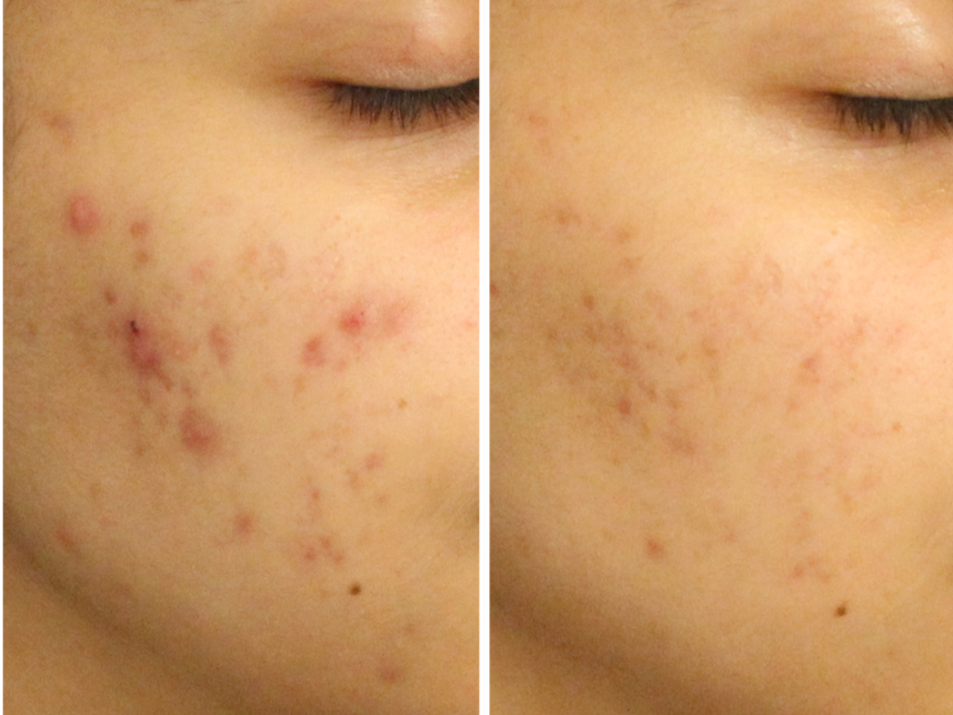 Before-and-after close-up of a cheek showing reduced acne blemishes and redness