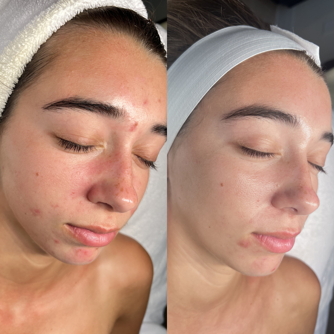 Before-and-after close-up of a woman’s facial skin showing reduced acne redness and blemishes