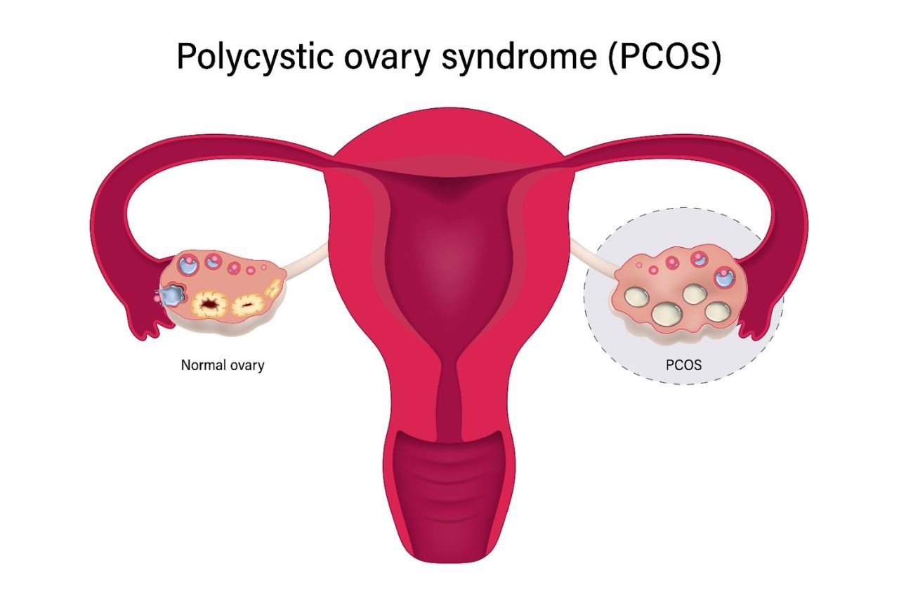 PCOS and Fertility: How Acupuncture May Support Your Journey