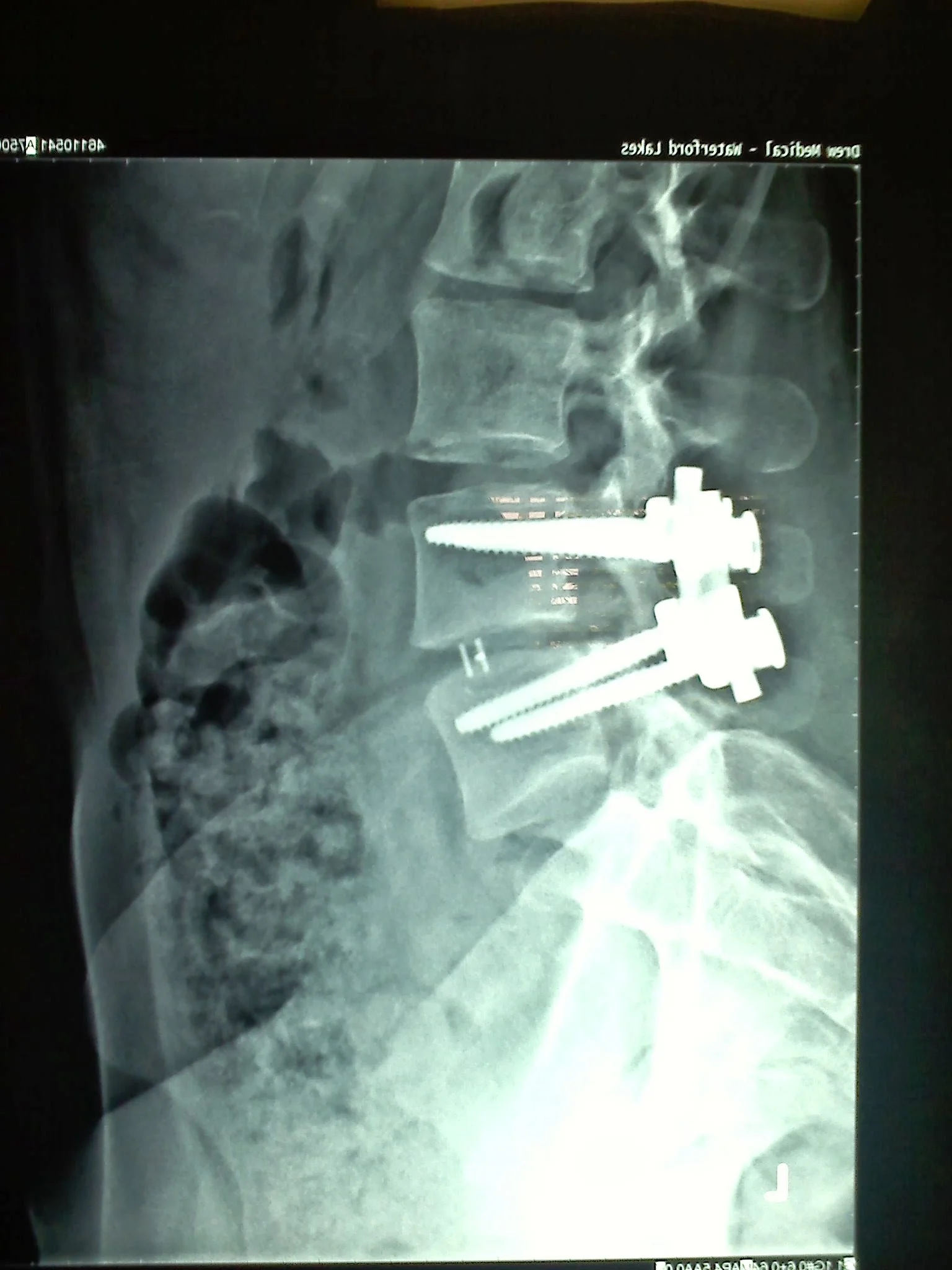 The Biggest Mistake I Made After Three Back Surgeries