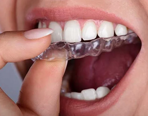 Person peeling off a clear dental retainer from their upper teeth.