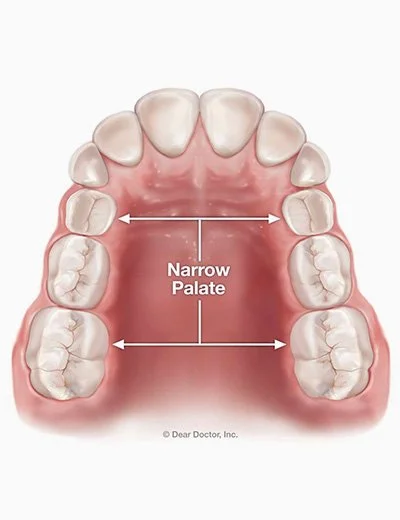 Diagram of the upper teeth showing a narrow palate, with arrows pointing to the width of the palate.