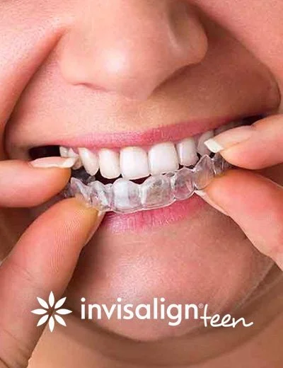 Person holding a clear Invisalign Teen aligner over upper teeth