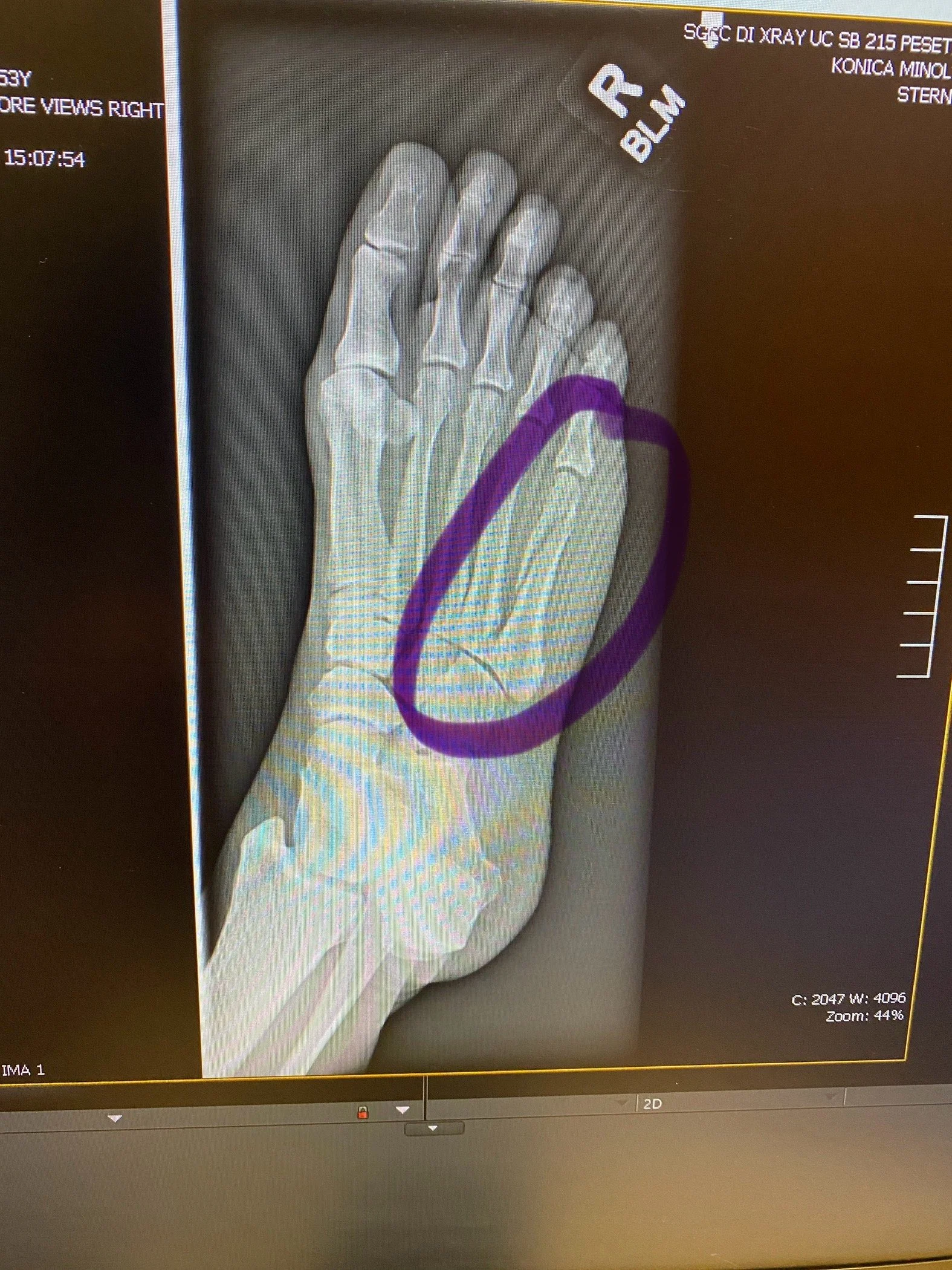 Lessons from a Broken Foot