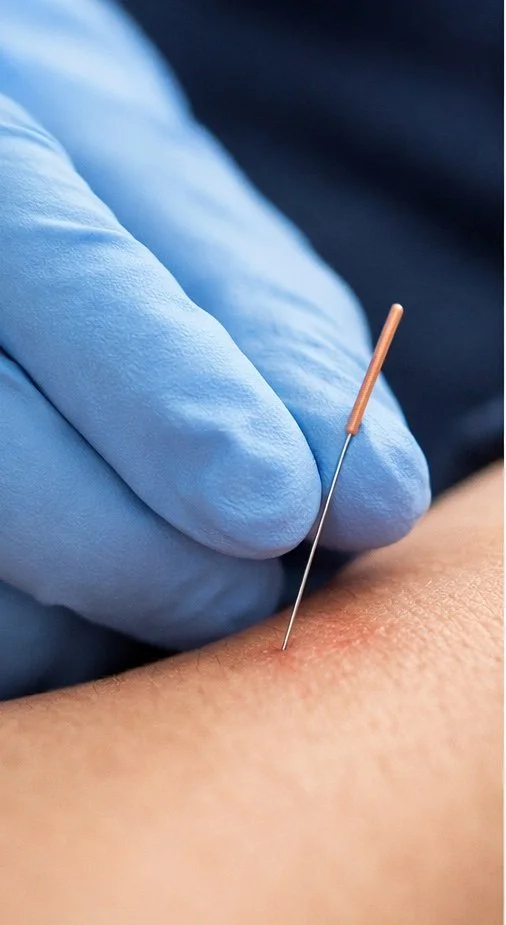 Close-up of a person receiving an acupuncture treatment, with a practitioner inserting a thin acupuncture needle into the skin.