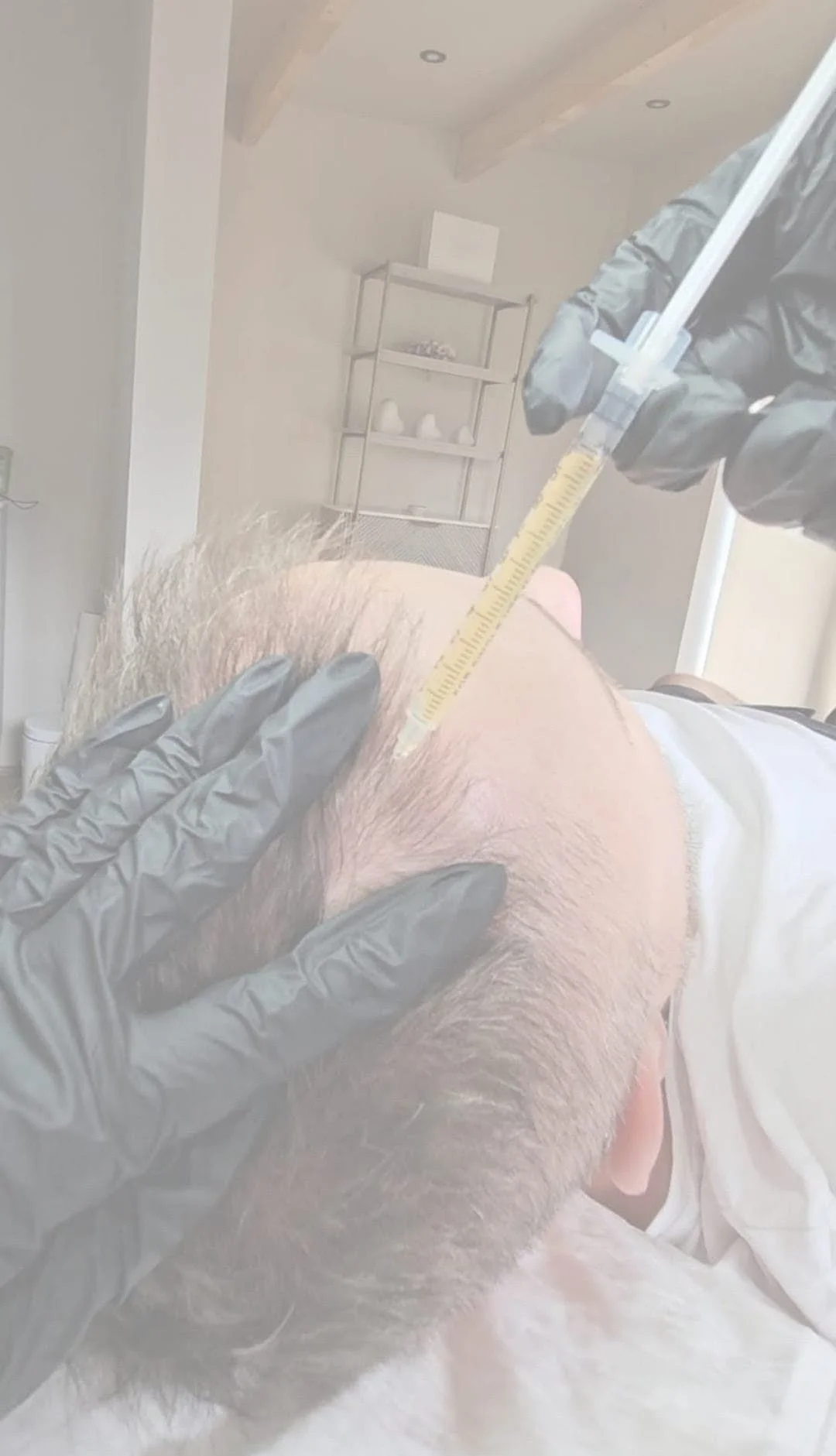 Hair Loss Treatments