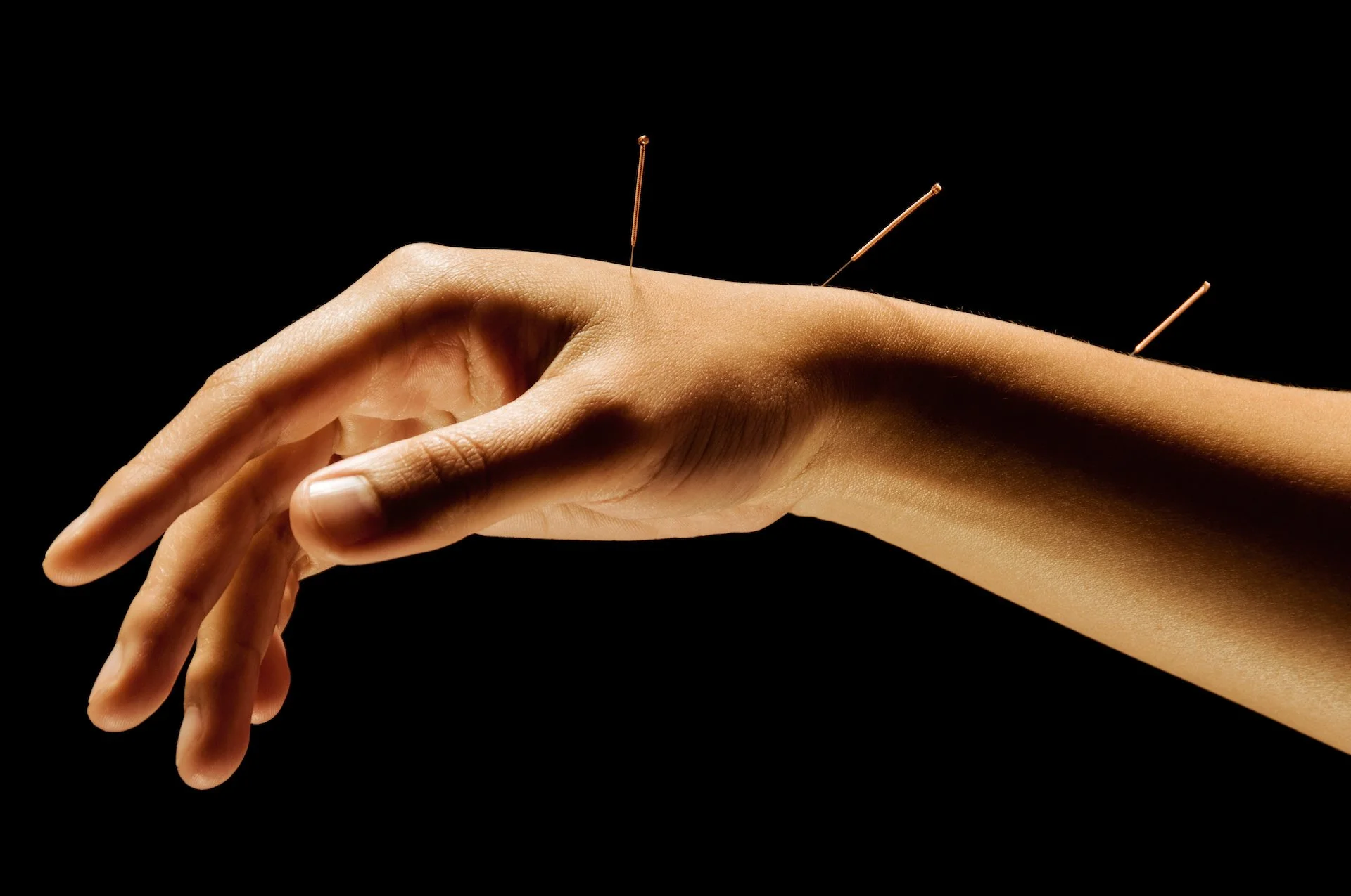 Close-up of a human hand with acupuncture needles inserted into the fingers and arm against a black background.