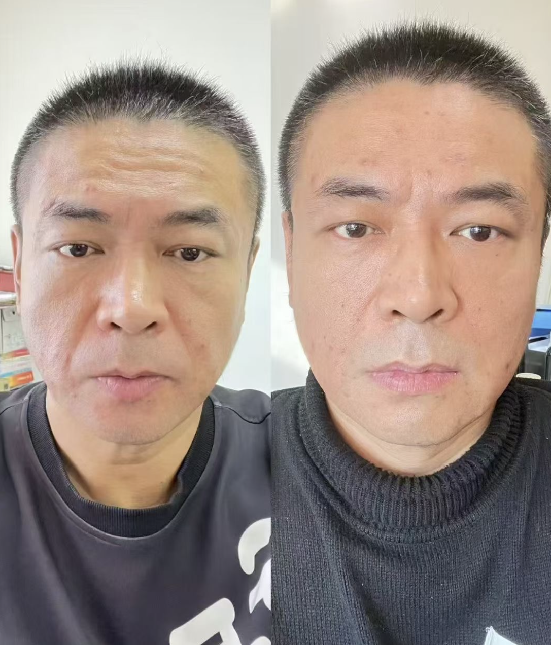 Side-by-side comparison of a man before and after facial treatment, showing smoother and clearer skin in the after photo.