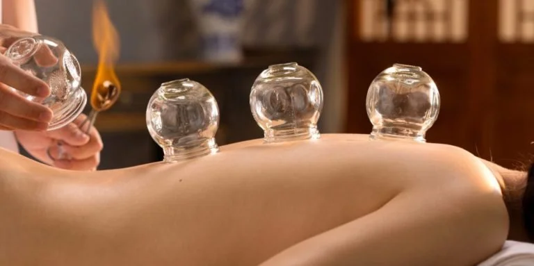 Person receiving cupping therapy with three glass cups on their back, with a flame preparing the cups.