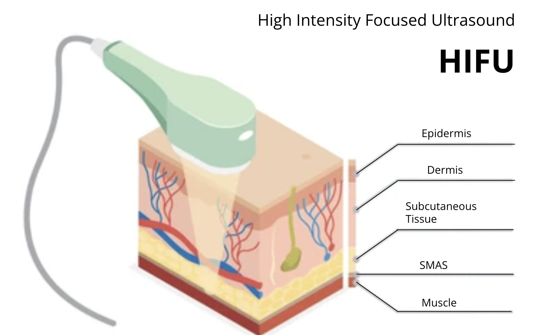An illustration of high-intensity focused ultrasound (HIFU) targeting skin layers, showing a device emitting ultrasound waves onto skin with labeled layers: epidermis, dermis, subcutaneous tissue, superficial muscular aponeurotic system (SMAS), and muscle.